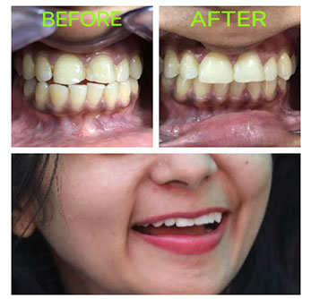 Cosmetic Dentisry in Vikaspuri